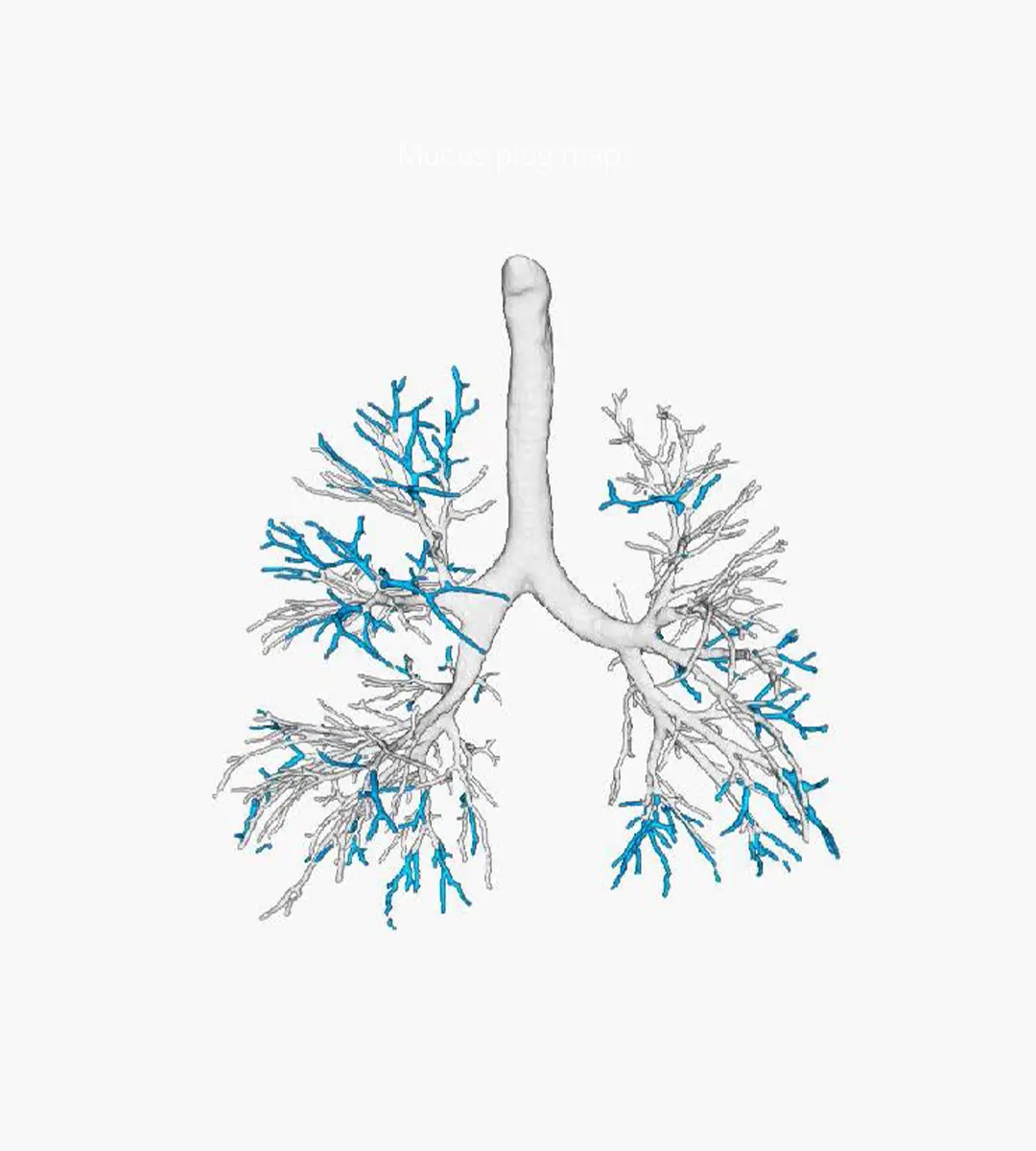 Bronchiectasis distribution bronchi