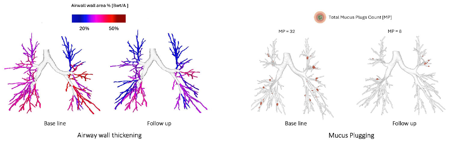 Examples-of-follow-up-treatment-effect,-quantified-with-AI-powered-analyses-LungQ